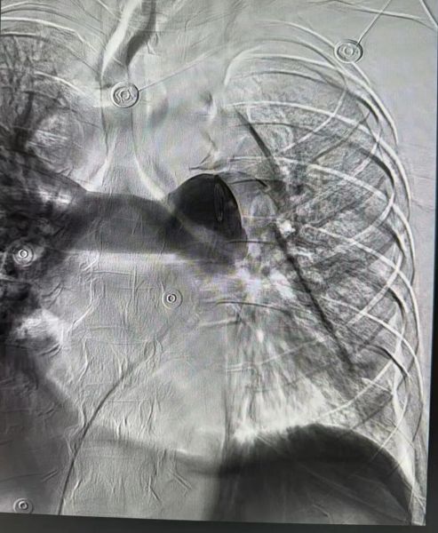 肺动脉造影,左肺动脉主干闭塞 肺动脉造影,左肺动脉主干闭塞