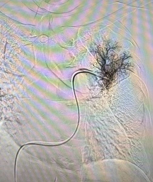 肺动脉溶栓后 肺动脉溶栓后